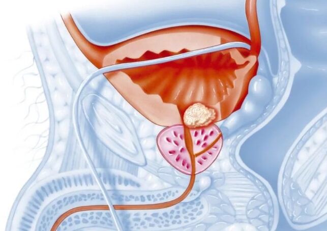 Caracteristici ale formei cronice de prostatită