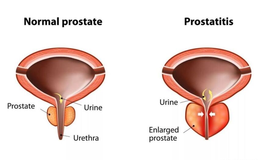 Prostată normală și inflamată