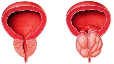 Prostată sănătoasă și inflamată cu prostatită